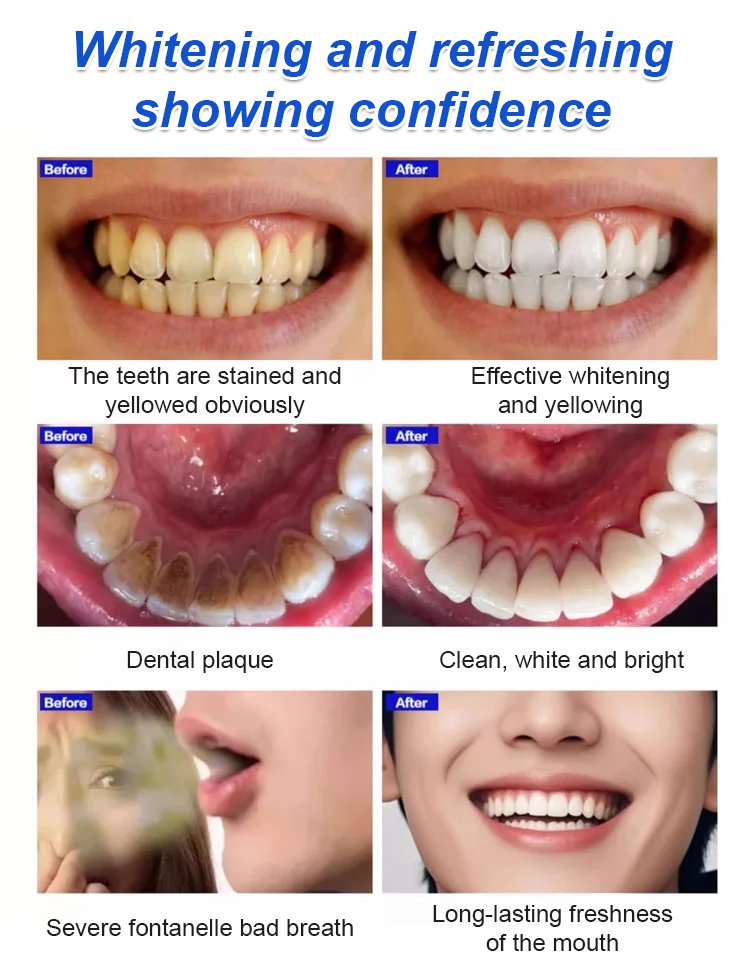 🦷BBOJI Teeth Whitening Gel  Colour Corrector